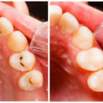 Composite Tooth-Colored Fillings