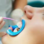 Dental Sealants