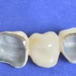 PFM Crowns