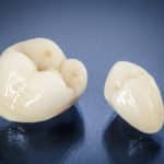 Provisional Restorations