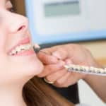Veneers