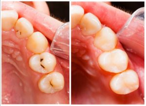 Composite fillings, tooth-colored