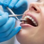 Deep Tooth Cleaning