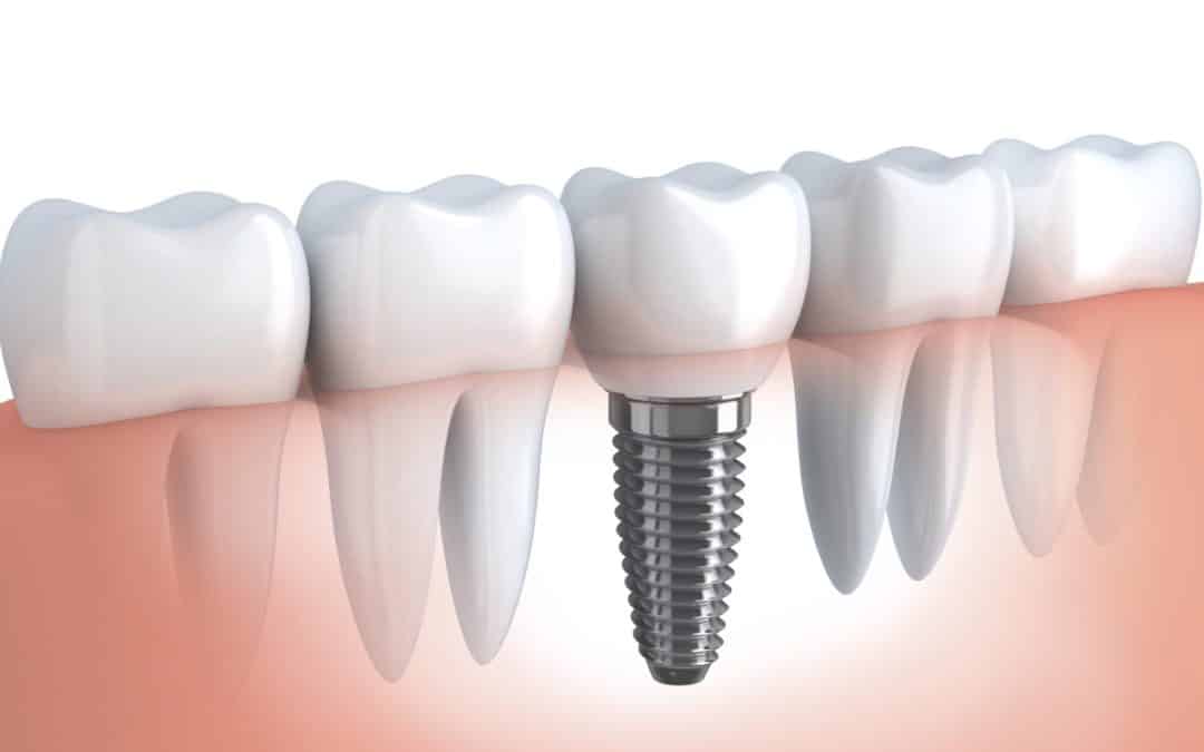 What are my options to replace missing teeth?