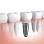 Dental implant