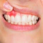 Periodontitis Disease Treatment
