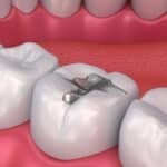 amalgam dental fillings