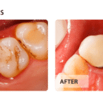 Tooth colored fillings