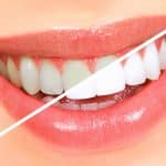 Teeth whitening