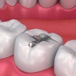 Dental Fillings